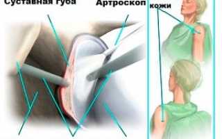 Повреждение суставной губы плечевого сустава