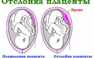 Отслоение плаценты на ранних сроках беременности