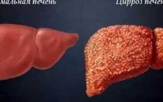 Болезни печени и суставы