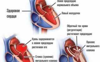 Гипертрофия (увеличение) левого предсердия: причины и симптомы, лечение и прогноз