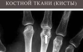 Кистозная перестройка костной ткани