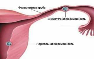 Что такое эктопическая беременность. Причины и диагностика эктопической беременности