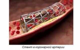 Алкоголь после стентирования и инфаркта – можно ли пить, и как не навредить здоровью?