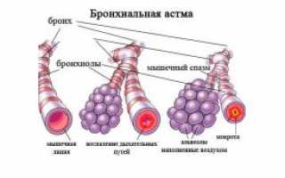 Бициллин и суставы