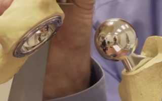 Протезы тазобедренного сустава Depuy