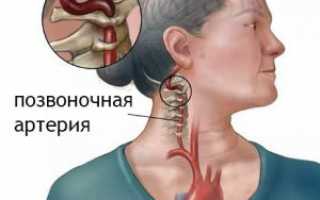 Кавинтон от остеохондроза