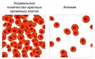 Операция при остеомиелите