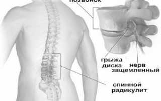 Вытягивание позвоночника при грыже