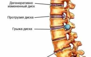 Лечение остеохондроза лазером