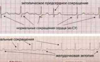 Предсердный эктопический ритм: признаки и лечение