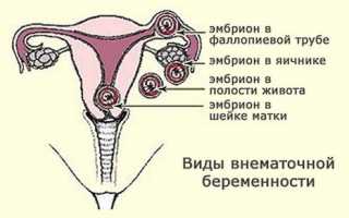 Беременность после внематочной беременности